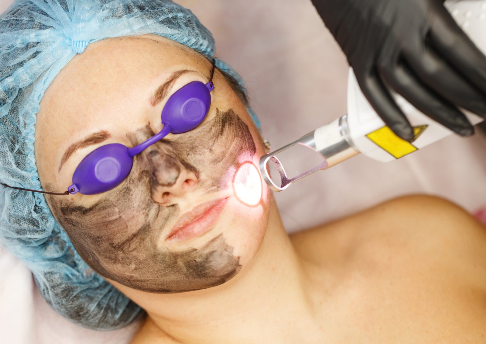 Carbon Laser Facial