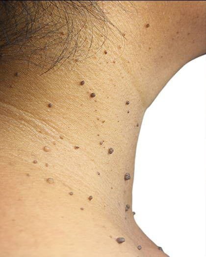 Mole / Skin Tag Removal