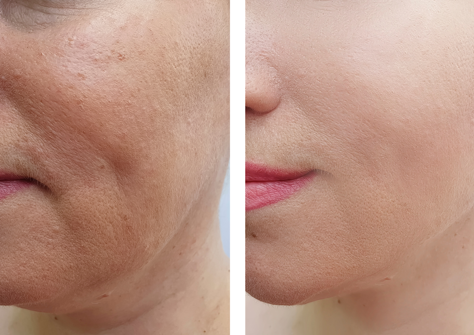 Pigmentation Treatment